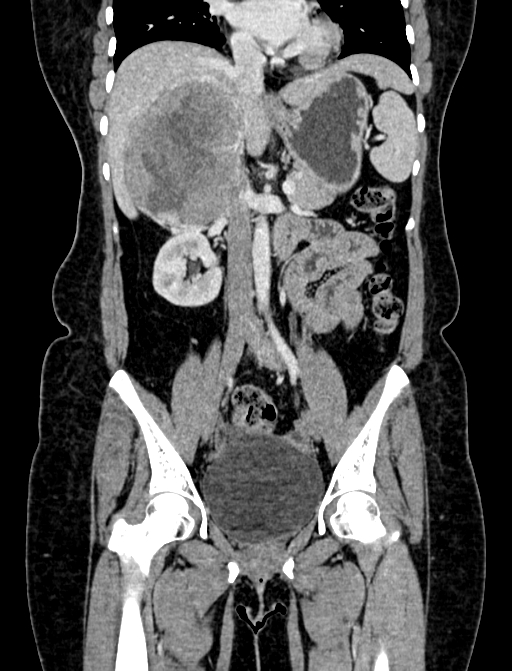 Adrenocortical carcinoma (Radiopaedia 87281-103569 Coronal C+ portal venous phase 46).jpg