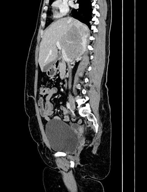 Adrenocortical carcinoma (Radiopaedia 87281-103569 Sagittal C+ portal venous phase 119).jpg