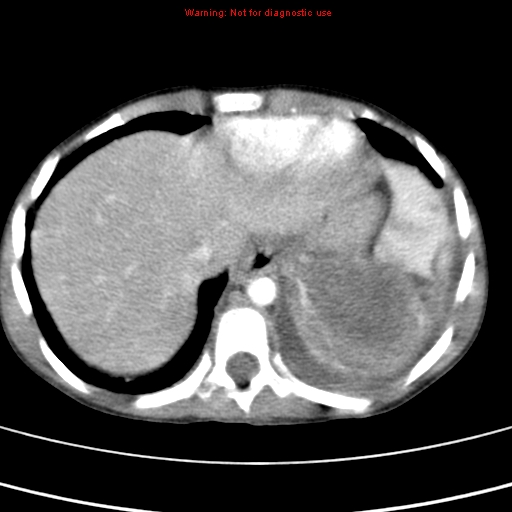 File:Adrenocortical carcinoma (Radiopaedia 9449-10131 Axial C+ portal venous phase 6).jpg