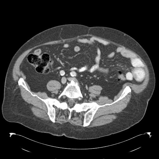 Adult ileal intussusception with secondary obstruction (Radiopaedia 30395-31051 Axial C+ portal venous phase 53).jpg
