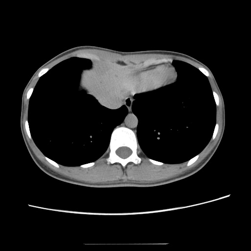 File:Adult polycystic kidney disease (Radiopaedia 48845-53876 Axial renal excretory phase 15).jpg