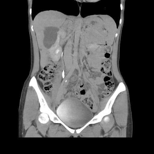 File:Adult polycystic kidney disease (Radiopaedia 48845-53876 Coronal renal excretory phase 20).jpg