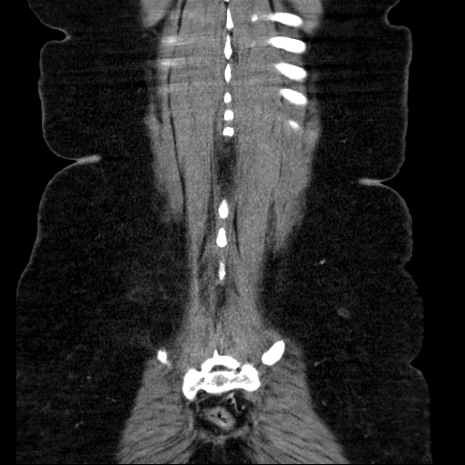 File:Afferent loop syndrome - secondary to incarcerated trocar site hernia (Radiopaedia 82959-97305 Coronal C+ portal venous phase 127).jpg
