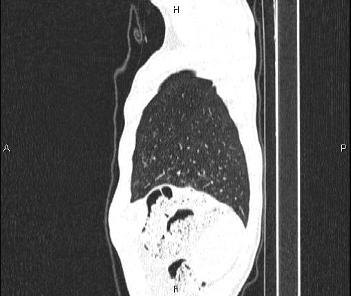 File:Air bronchogram in pneumonia (Radiopaedia 85719-101512 Sagittal lung window 92).jpg