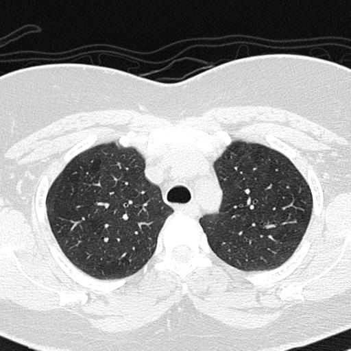 Air trapping in small airway disease (Radiopaedia 61685-69694 Axial lung window 41).jpg