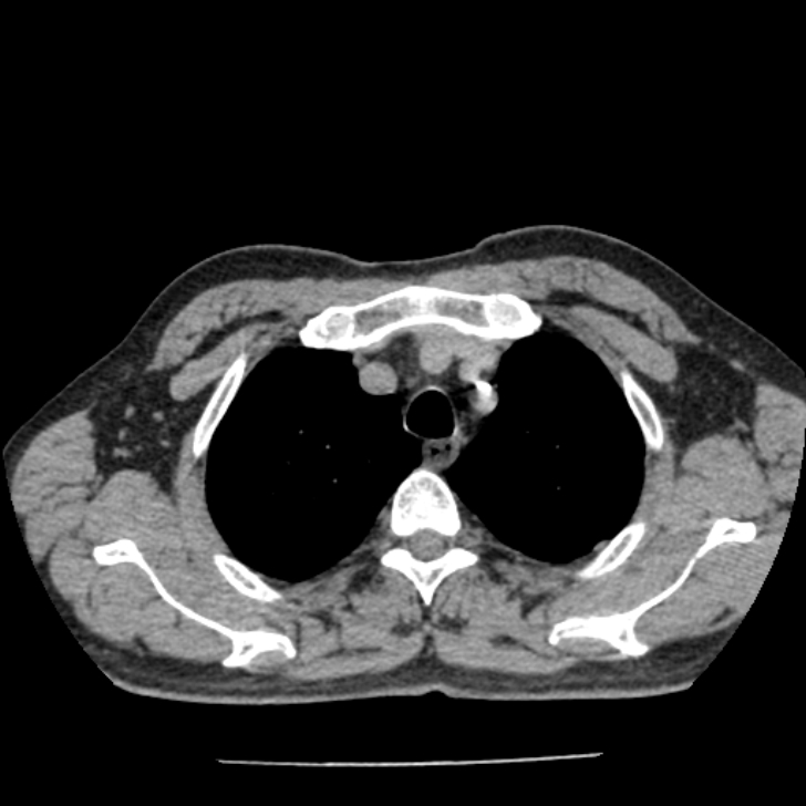 Airway foreign body in adult (Radiopaedia 85907-101779 Axial liver window 18).jpg