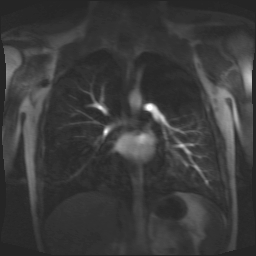 File:Alagille syndrome with pulmonary hypertension (Radiopaedia 49384-54502 B 1).jpg