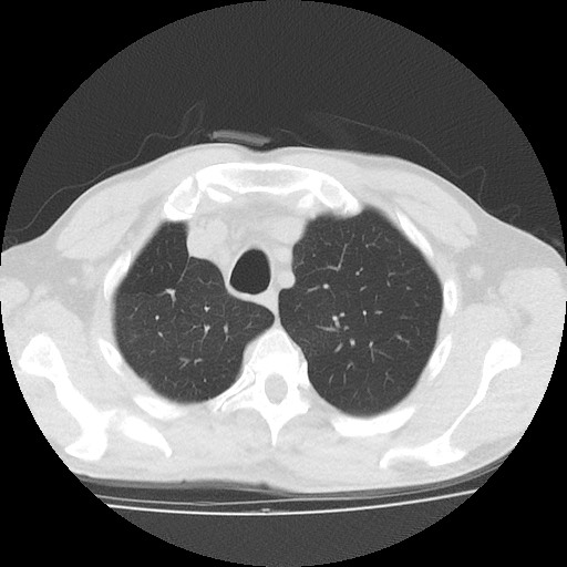 Allergic bronchopulmonary aspergillosis (ABPA) (Radiopaedia 60594-68313 Axial lung window 10).jpg