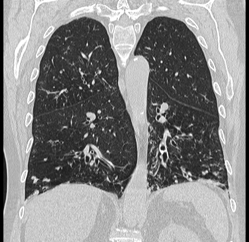 Alpha-1-antitrypsin deficiency (Radiopaedia 72058-82557 Coronal lung window 60).jpg