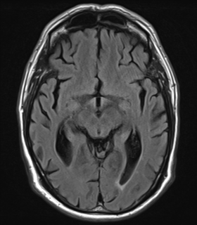 File:Alzheimer's disease- with Gerstmann syndrome and dressing apraxia (Radiopaedia 54882-61150 Axial FLAIR 12).png