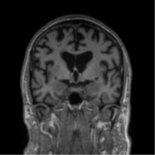 Alzheimer's disease- with Gerstmann syndrome and dressing apraxia (Radiopaedia 54882-61150 Coronal T1 52).png