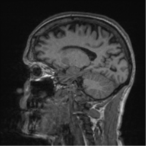 File:Alzheimer's disease- with apraxia (Radiopaedia 54763-61011 Sagittal T1 26).png