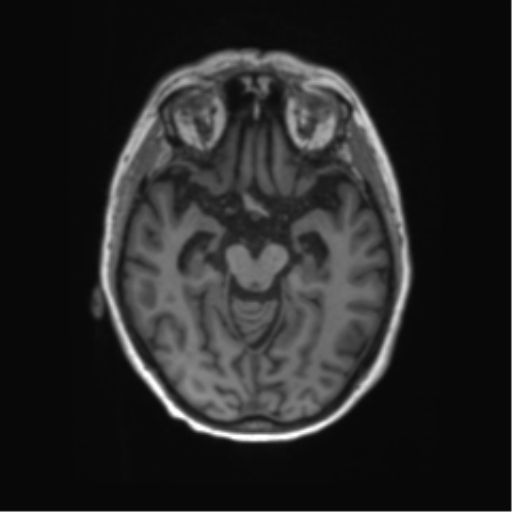 File:Alzheimer's disease (Radiopaedia 42658-45802 Axial T1 95).png
