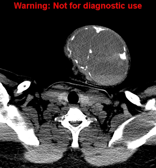 File:Ameloblastoma (Radiopaedia 33126-34164 A 33).jpg