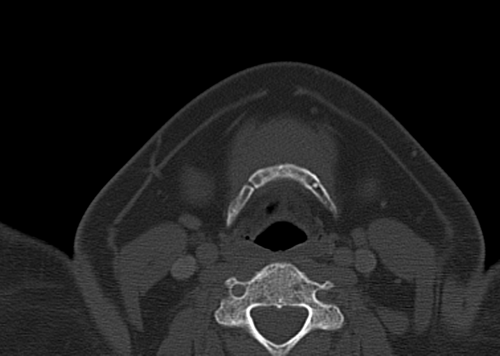 File:Ameloblastoma (Radiopaedia 38520-40623 D 45).png