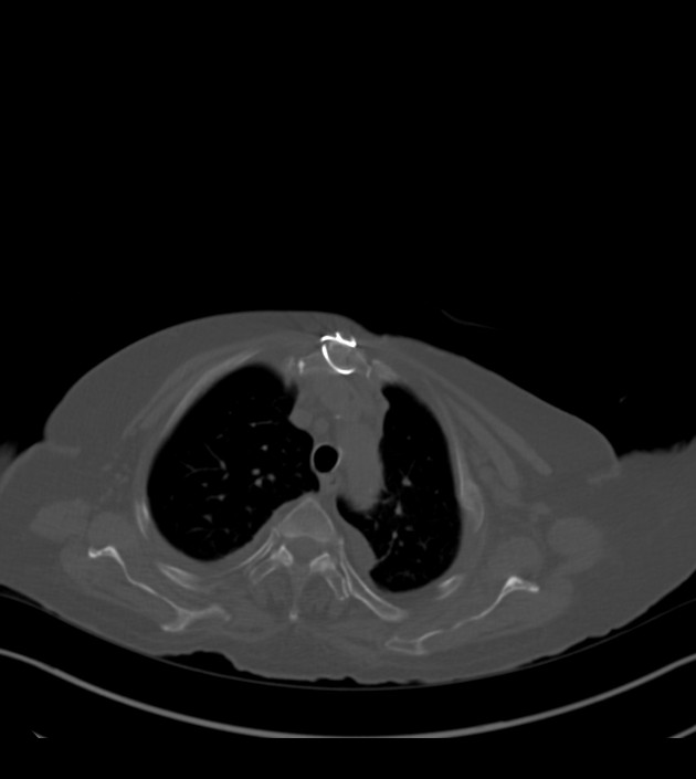 Amiodarone deposition in the liver (Radiopaedia 77587-89780 Axial bone window 19).jpg
