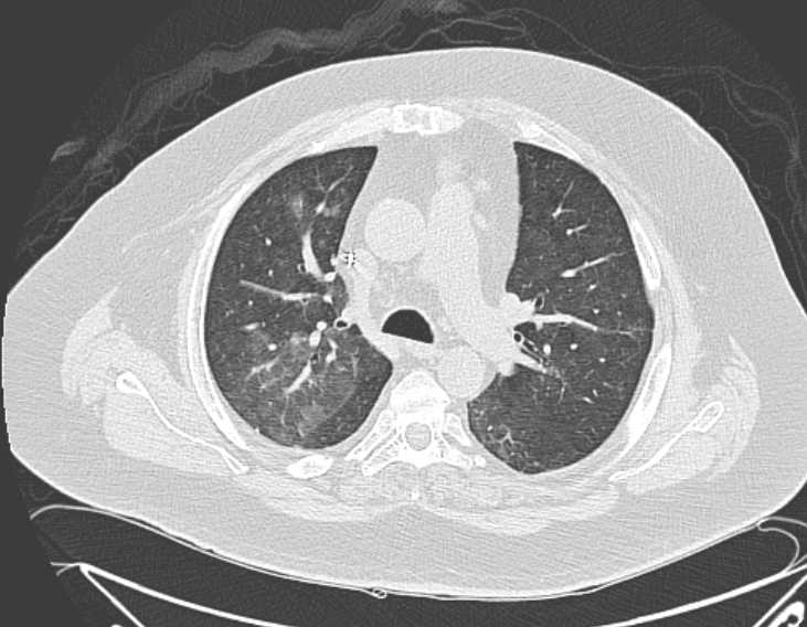 Amiodarone lung (Radiopaedia 62514-70769 Axial lung window 34).jpg