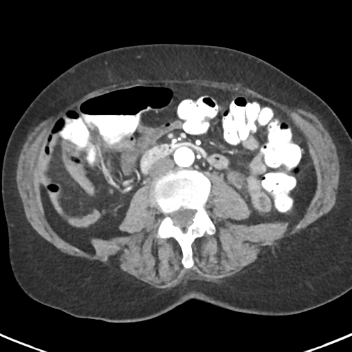 Ampullary adenocarcinoma (Radiopaedia 34013-35237 B 54).png