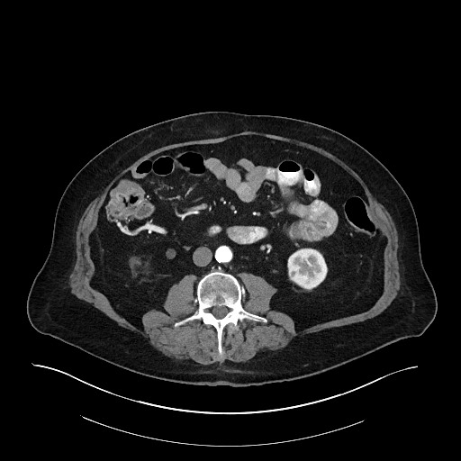 Ampullary adenocarcinoma (Radiopaedia 59373-66734 A 89).jpg