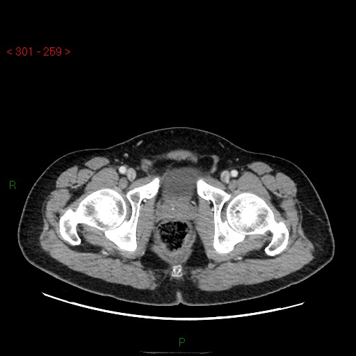File:Ampullary carcinoma (Radiopaedia 56396-63056 C 100).jpg