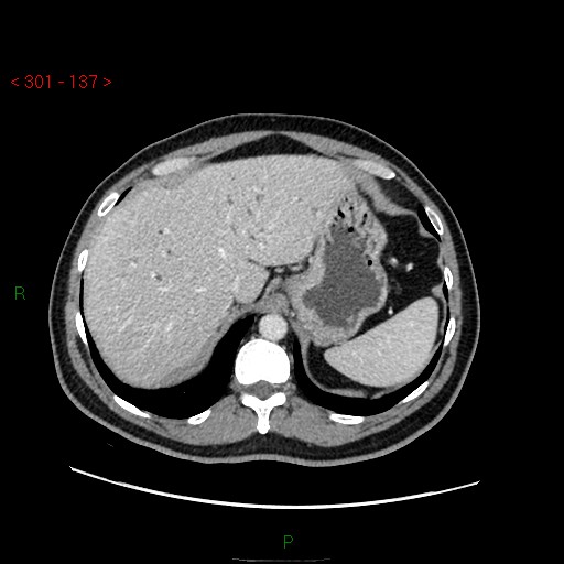 File:Ampullary carcinoma (Radiopaedia 56396-63056 C 19).jpg