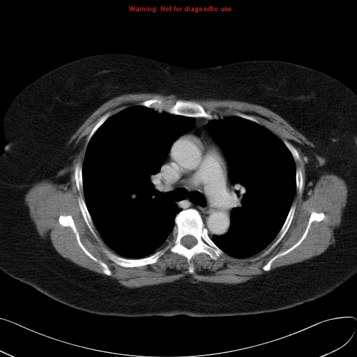 File:Ampullary tumor and double duct sign (Radiopaedia 24181).jpg