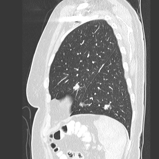 Amyloidosis - bronchial and diffuse nodular pulmonary involvement (Radiopaedia 60156-67745 Sagittal lung window 74).jpg