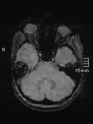 Amyotrophic lateral sclerosis (Radiopaedia 70821-81017 Axial SWI 10).jpg