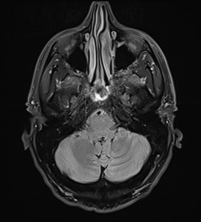 File:Amyotrophic lateral sclerosis (Radiopaedia 87352-103658 Axial FLAIR 5).jpg