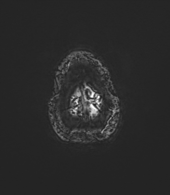 Anaplastic astrocytoma IDH mutant (Radiopaedia 50046-55341 Axial SWI 85).png