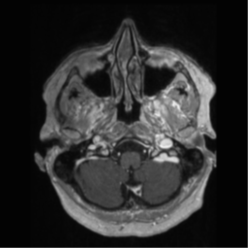 File:Anaplastic astrocytoma IDH wild-type (pseudoprogression) (Radiopaedia 42209-45277 Axial T1 C+ 13).png