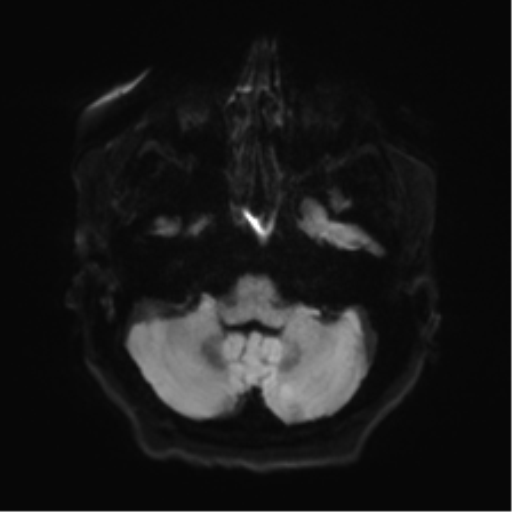 Anaplastic astrocytoma IDH wild-type (pseudoprogression) (Radiopaedia 42209-45279 Axial DWI 33).png