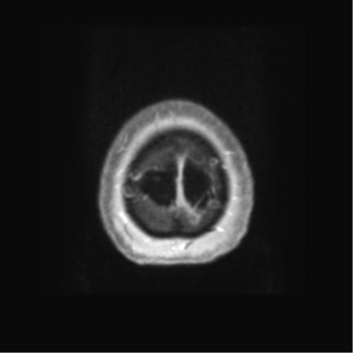 Anaplastic astrocytoma IDH wild-type (pseudoprogression) (Radiopaedia 42209-45279 Axial T1 C+ 137).png