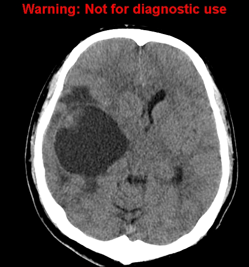 File:Anaplastic ganglioglioma (Radiopaedia 44921-48815 Axial non-contrast 12).jpg