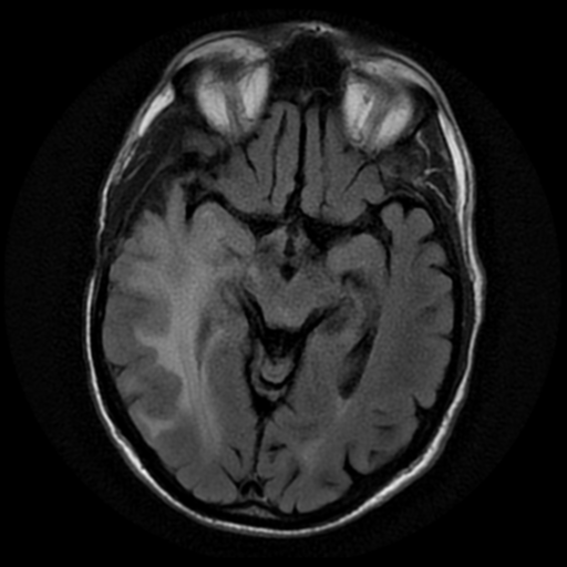 File:Anaplastic meningioma with recurrence (Radiopaedia 34452-35790 Axial T2 FLAIR 9).png