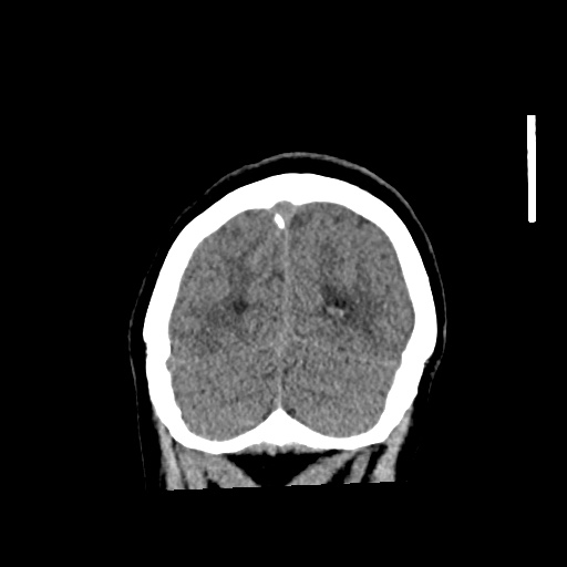 Aneursym related subarachnoid hemorrhage with hydrocephalus (Radiopaedia 45105-49083 Coronal non-contrast 57).jpg