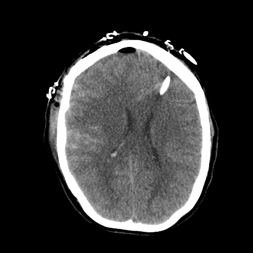 Aneursym related subarachnoid hemorrhage with hydrocephalus (Radiopaedia 45105-49085 Axial non-contrast 30).jpg