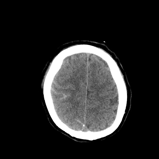 Aneursym related subarachnoid hemorrhage with hydrocephalus (Radiopaedia 45105-49085 Axial non-contrast 41).jpg