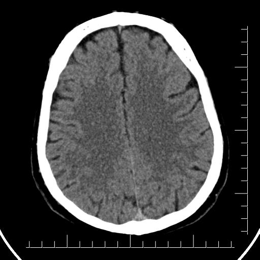 File:Aneurysm of posterior communicating artery (Radiopaedia 20188-20162 Axial non-contrast 33).jpg