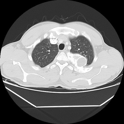 File:Aneurysmal bone cyst - rib (Radiopaedia 82167-96220 Axial lung window 20).jpg