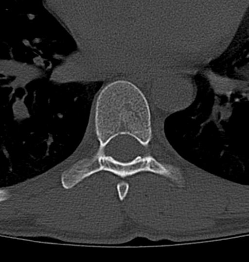 Aneurysmal bone cyst T11 (Radiopaedia 29294-29721 Axial bone window 14).jpg