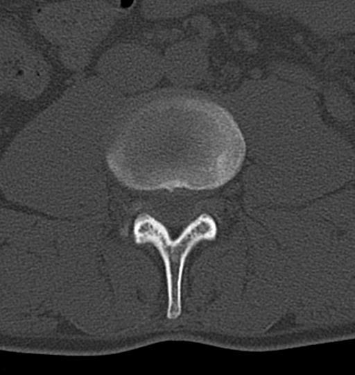 Aneurysmal bone cyst T11 (Radiopaedia 29294-29721 Axial bone window 93).jpg