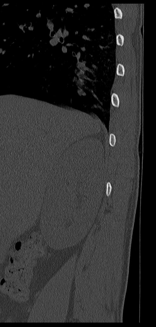 Aneurysmal bone cyst T11 (Radiopaedia 29294-29721 Sagittal bone window 81).jpg