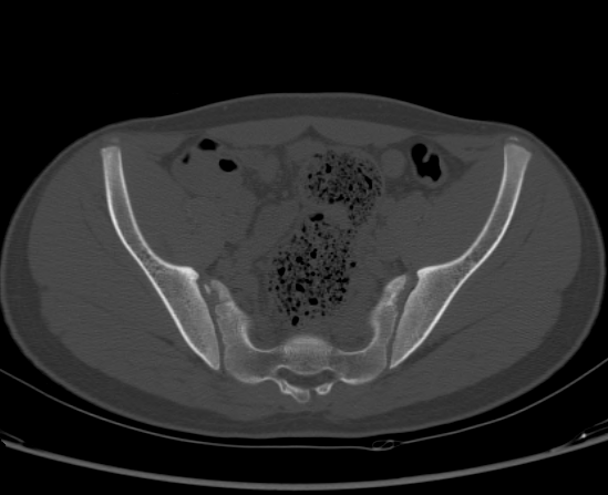 File:Aneurysmal bone cyst of ischium (Radiopaedia 25957-26094 Axial bone window 31).png