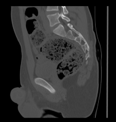Aneurysmal bone cyst of ischium (Radiopaedia 25957-26094 Sagittal bone window 41).png