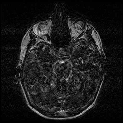 Angioinvasive aspergillosis in the pituitary fossa (Radiopaedia 39676-42010 Ax 3D FIESTA VOLUME 52).png