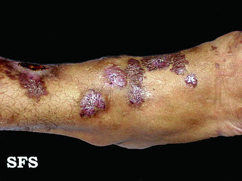 Angiokeratoma Circumscriptum (Dermatology Atlas 8).jpg