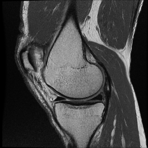 Anomalous insertion of the medial meniscus (Radiopaedia 77559-89721 Sagittal PD 37).jpg
