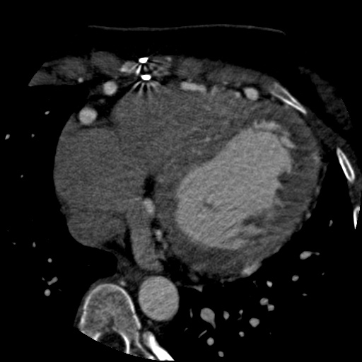 File:Anomalous left coronary artery from the pulmonary artery (ALCAPA) (Radiopaedia 40884-43586 A 57).jpg