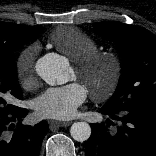 File:Anomalous origin of the left coronary artery with malignant course (Radiopaedia 77842-90126 C 81).jpeg